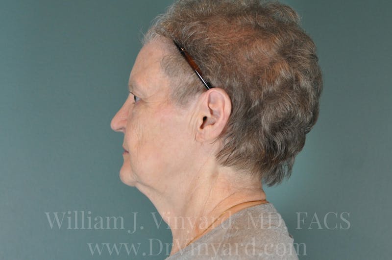 Facelift Before & After Gallery - Patient 169743473 - Image 9