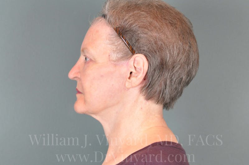 Facelift Before & After Gallery - Patient 169743473 - Image 10