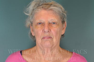 Facelift Before & After Gallery - Patient 169743990 - Image 1