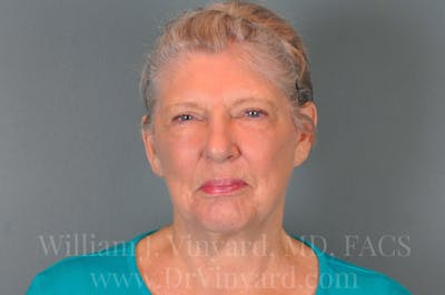 Facelift (Cheek and Neck Lift) Before & After Gallery - Patient 169743990 - Image 2