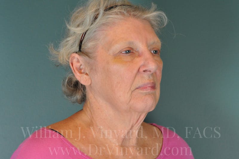 Facelift Before & After Gallery - Patient 169743990 - Image 3