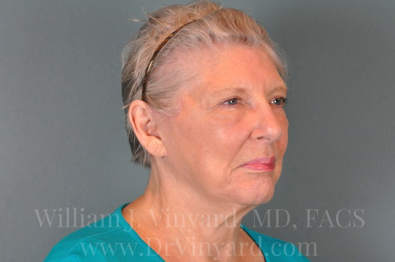 Facelift Before & After Gallery - Patient 169743990 - Image 4