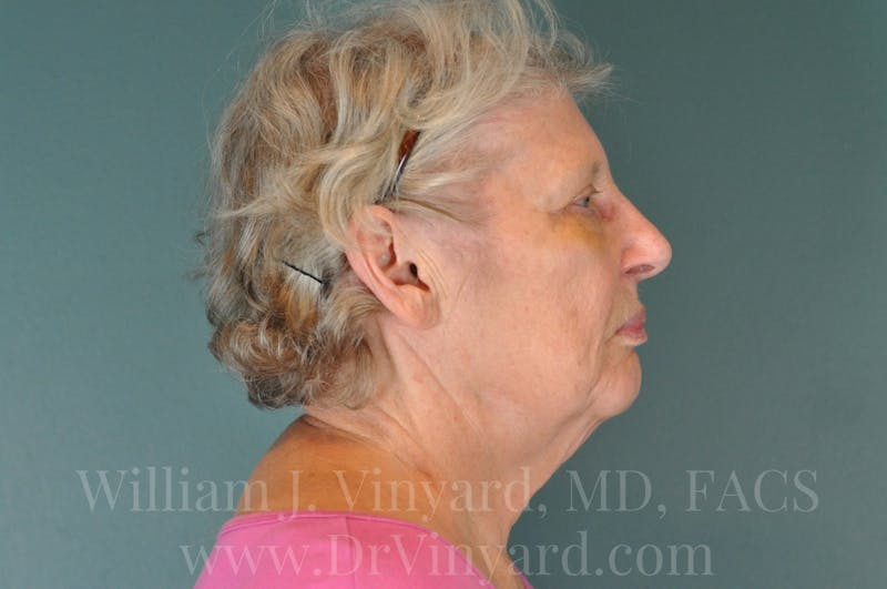 Facelift Before & After Gallery - Patient 169743990 - Image 5