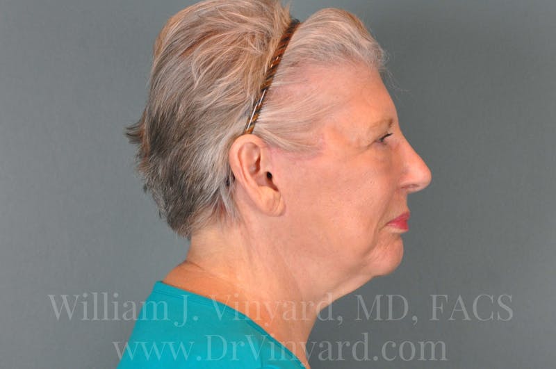 Facelift Before & After Gallery - Patient 169743990 - Image 6