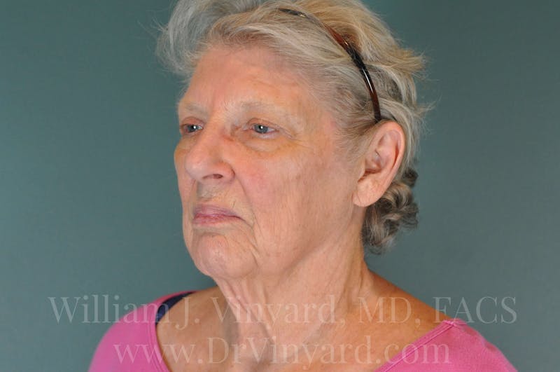 Facelift Before & After Gallery - Patient 169743990 - Image 7