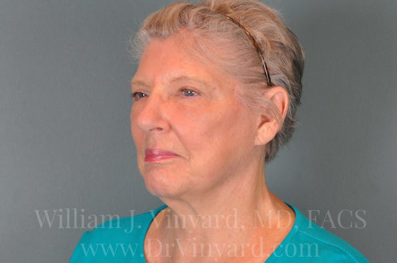 Facelift Before & After Gallery - Patient 169743990 - Image 8