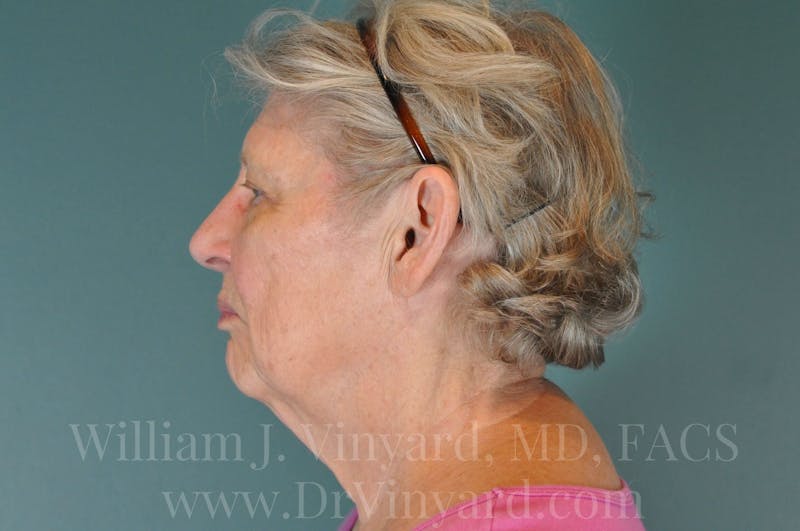 Facelift Before & After Gallery - Patient 169743990 - Image 9