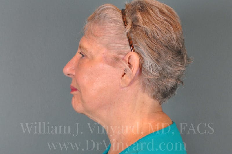 Facelift Before & After Gallery - Patient 169743990 - Image 10