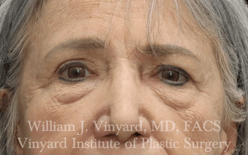 Eyelid Before & After Gallery - Patient 169744024 - Image 1