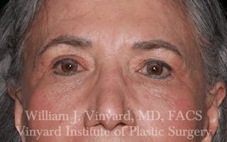 Eyelid Before & After Gallery - Patient 169744024 - Image 2