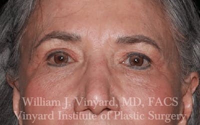Eyelid Before & After Gallery - Patient 169744024 - Image 2