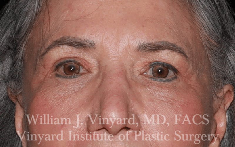 Eyelid Before & After Gallery - Patient 169744024 - Image 2