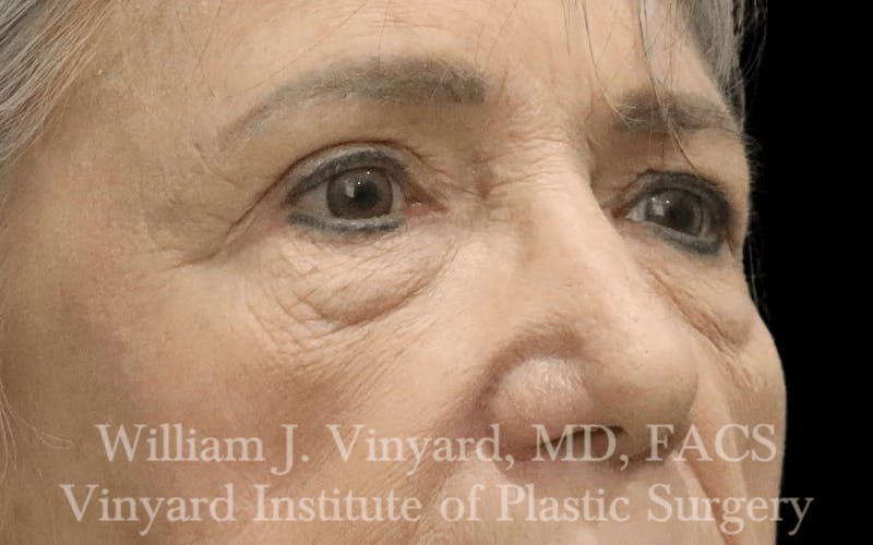 Eyelid Before & After Gallery - Patient 169744024 - Image 3