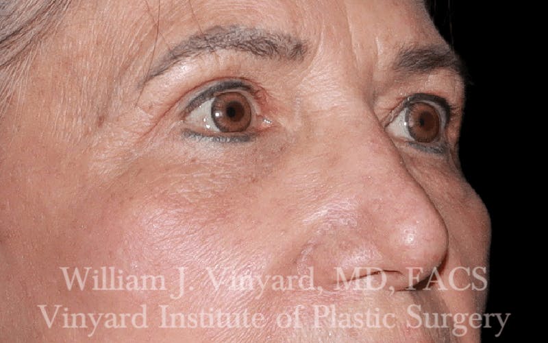 Eyelid Before & After Gallery - Patient 169744024 - Image 4