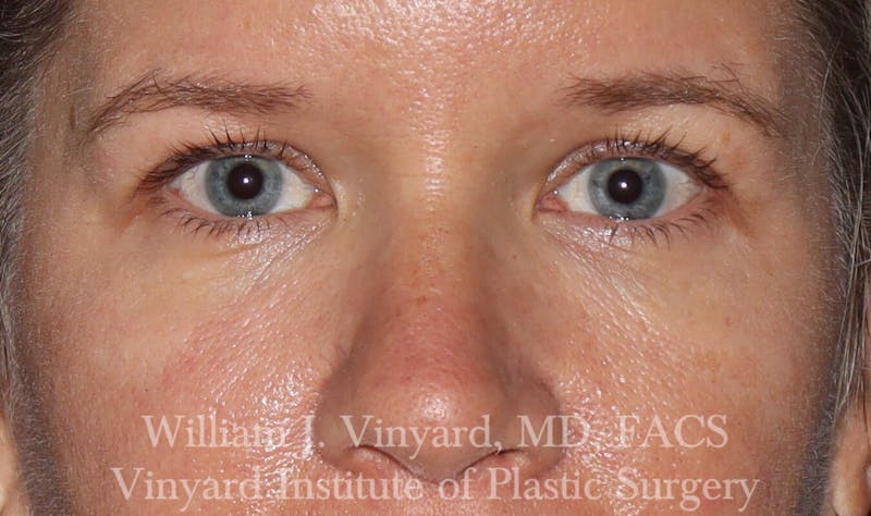 Eyelid Surgery