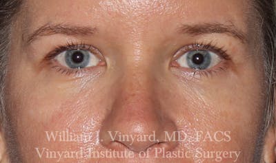 Eyelid Before & After Gallery - Patient 169744027 - Image 1