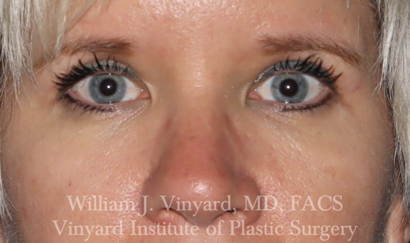 Eyelid Before & After Gallery - Patient 169744027 - Image 2