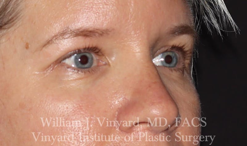 Eyelid Before & After Gallery - Patient 169744027 - Image 3