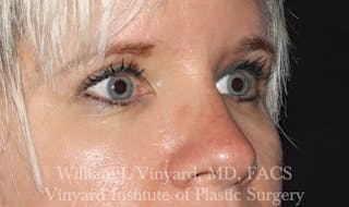 Eyelid Before & After Gallery - Patient 169744027 - Image 4
