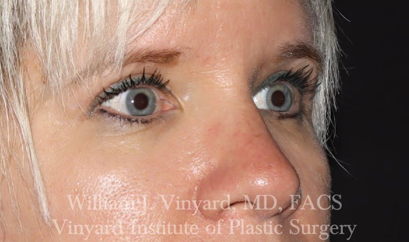 Eyelid Before & After Gallery - Patient 169744027 - Image 4