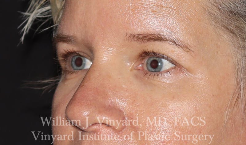 Eyelid Before & After Gallery - Patient 169744027 - Image 5