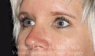 Eyelid Before & After Gallery - Patient 169744027 - Image 6