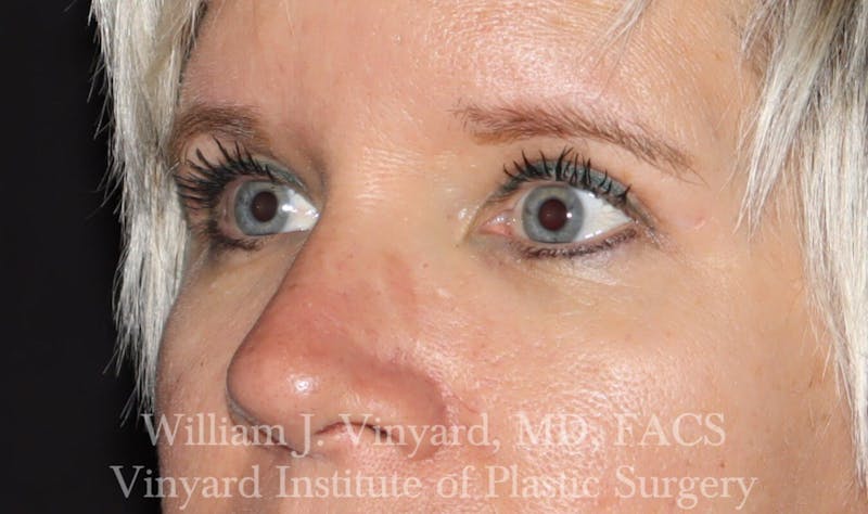 Eyelid Before & After Gallery - Patient 169744027 - Image 6