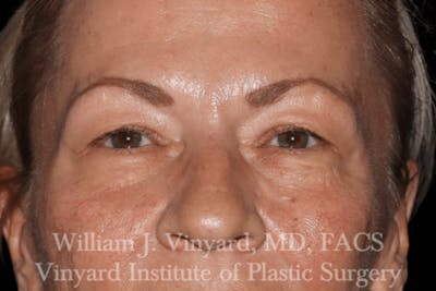 Eyelid Before & After Gallery - Patient 169744029 - Image 1