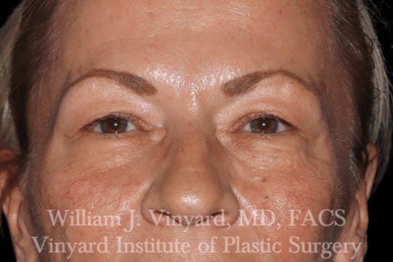 Eyelid Before & After Gallery - Patient 169744029 - Image 1