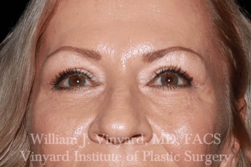 Eyelid Before & After Gallery - Patient 169744029 - Image 2