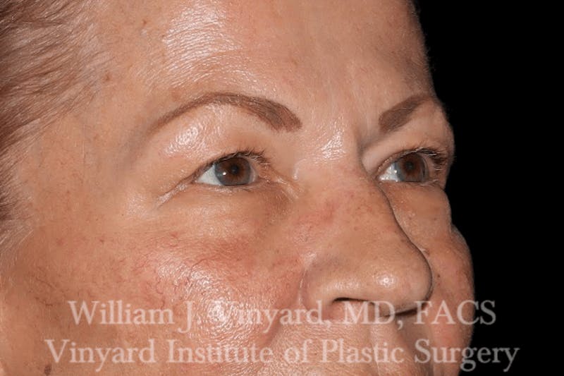 Eyelid Before & After Gallery - Patient 169744029 - Image 3