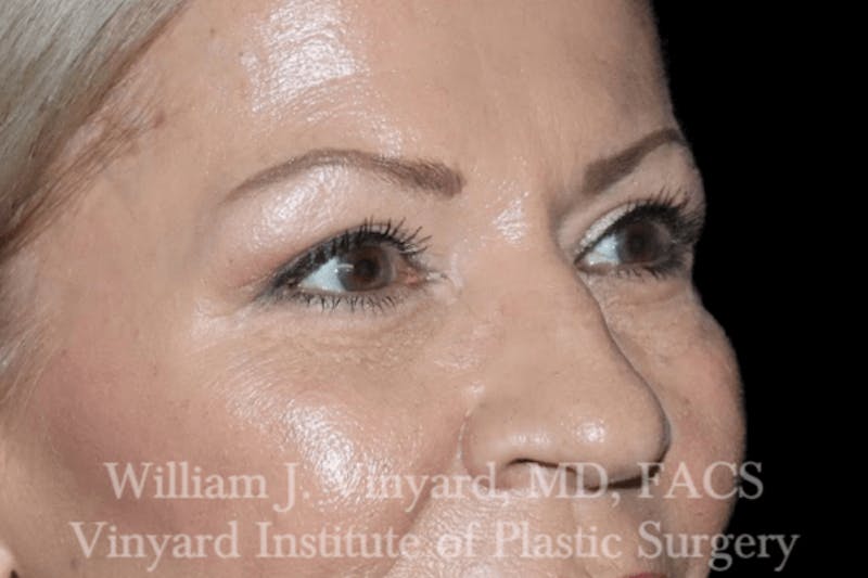 Eyelid Before & After Gallery - Patient 169744029 - Image 4