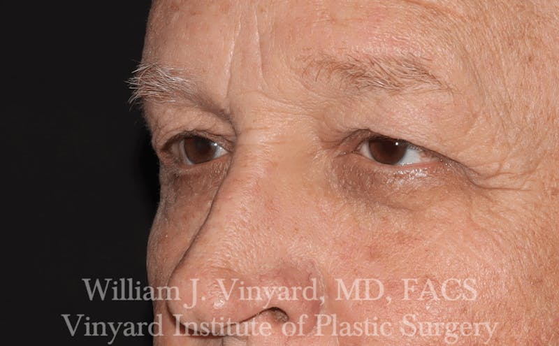 Eyelid Before & After Gallery - Patient 169744031 - Image 1