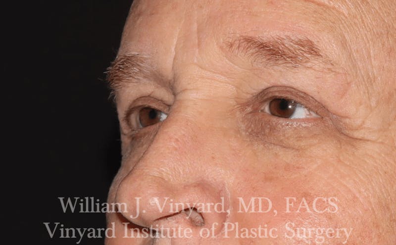Eyelid Before & After Gallery - Patient 169744031 - Image 2