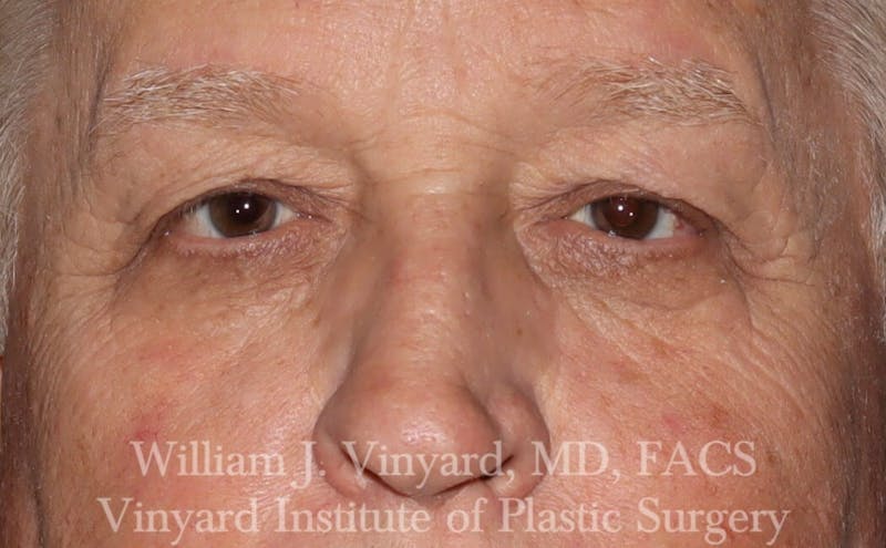 Eyelid Before & After Gallery - Patient 169744031 - Image 3