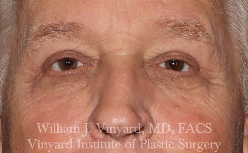 Eyelid Before & After Gallery - Patient 169744031 - Image 4