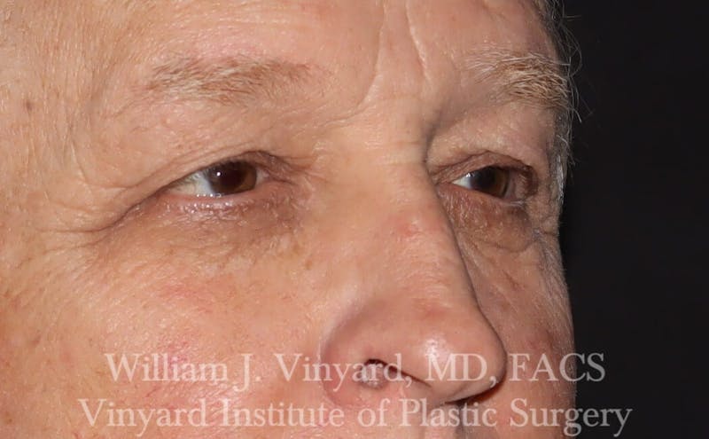 Eyelid Before & After Gallery - Patient 169744031 - Image 5
