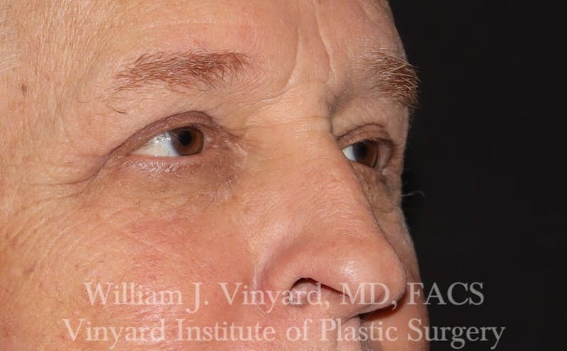 Eyelid Before & After Gallery - Patient 169744031 - Image 6