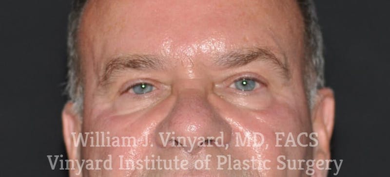 Eyelid Before & After Gallery - Patient 169744032 - Image 1