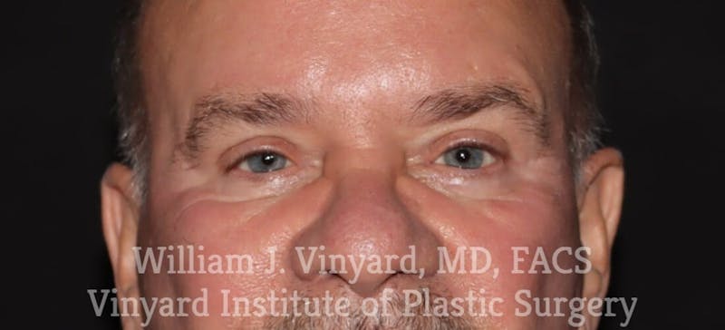 Eyelid Before & After Gallery - Patient 169744032 - Image 2