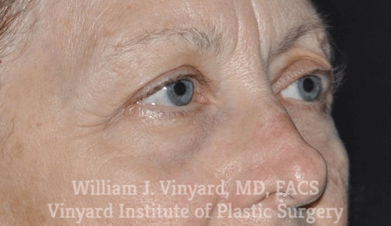 Eyelid Before & After Gallery - Patient 169744034 - Image 1