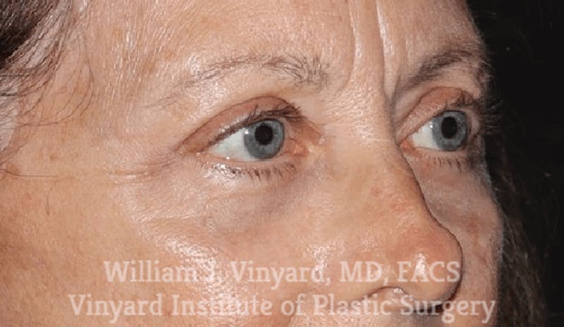 Eyelid Before & After Gallery - Patient 169744034 - Image 2