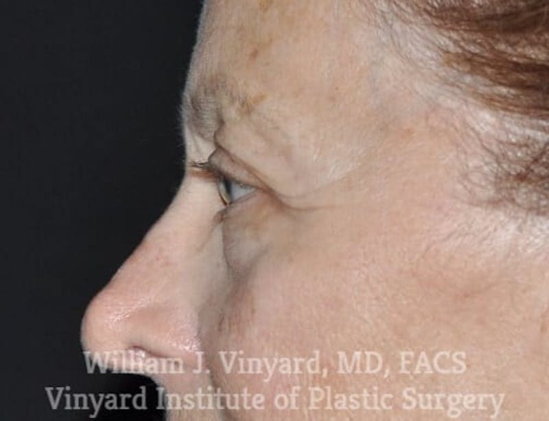 Eyelid Before & After Gallery - Patient 169744034 - Image 3