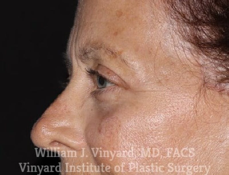 Eyelid Before & After Gallery - Patient 169744034 - Image 4