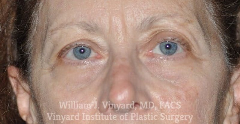 Eyelid Before & After Gallery - Patient 169744034 - Image 5