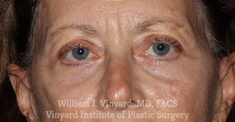 Eyelid Before & After Gallery - Patient 169744034 - Image 6