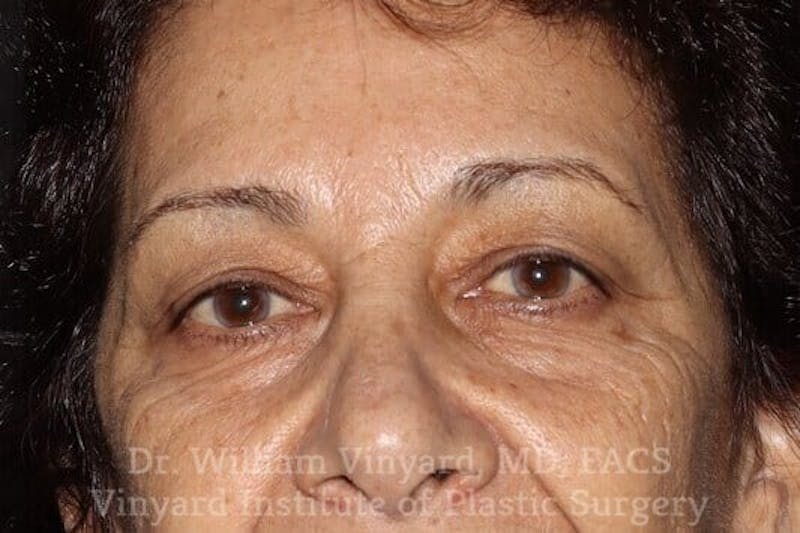 Eyelid Before & After Gallery - Patient 169744037 - Image 1