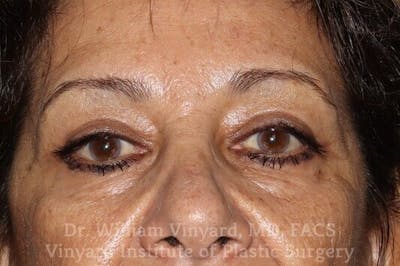 Eyelid Before & After Gallery - Patient 169744037 - Image 2