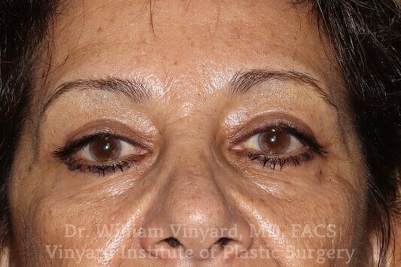 Eyelid Before & After Gallery - Patient 169744037 - Image 2