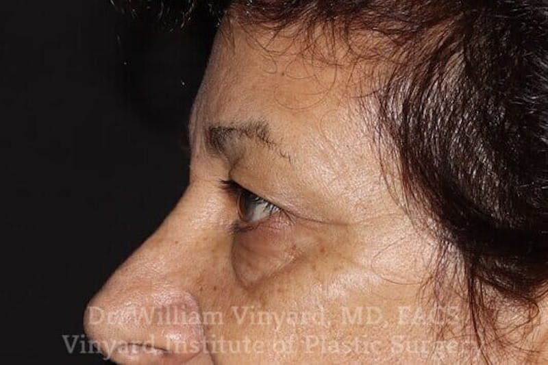 Eyelid Before & After Gallery - Patient 169744037 - Image 3